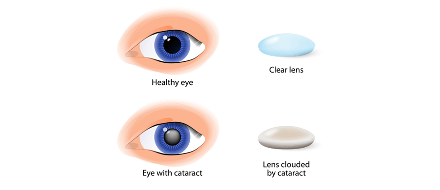 What Is a Monofocal Lens? Deep Dive Into Its Features, Benefits, And Applications